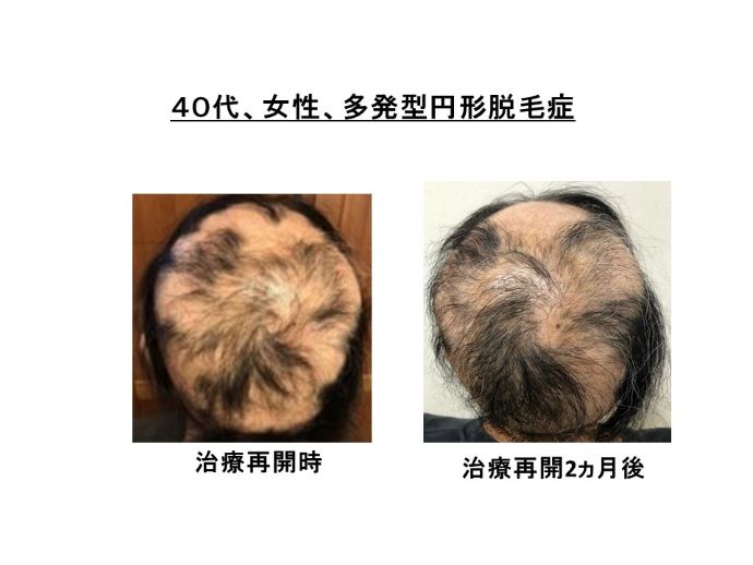 円形脱毛症　病院